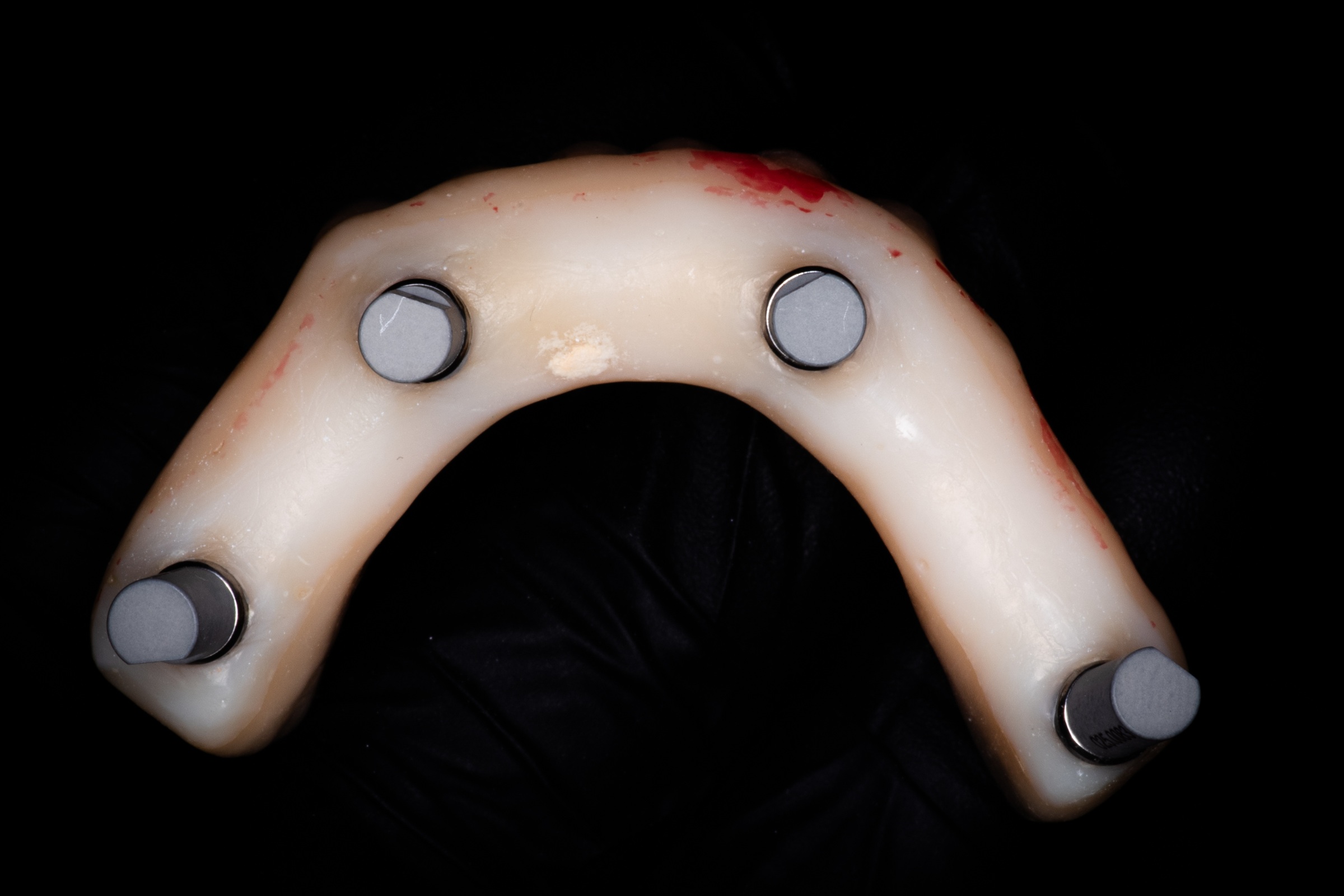 Intaglio surface of a full-arch implant-supported prosthesis with four titanium abutment cylinders bonded in place