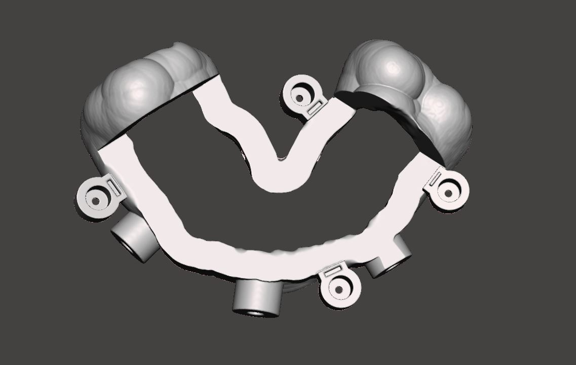 CAD design of a full-arch surgical guide with implant sleeves and anchor pin positions