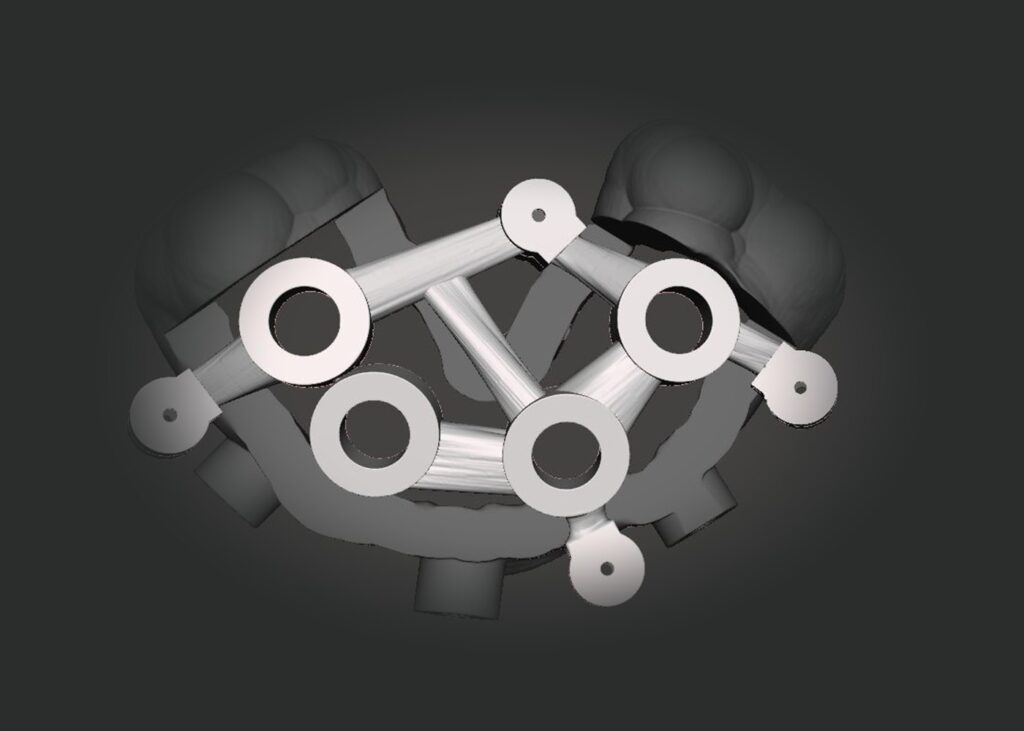 CAD design of a stackable full-arch surgical guide, top view, showing implant sleeves, anchor pin rings and connecting struts